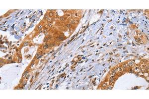 Immunohistochemistry of paraffin-embedded Human cervical cancer using CDK19 Polyclonal Antibody at dilution of 1:70 (CDK19 antibody)