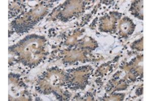 The image on the left is immunohistochemistry of paraffin-embedded Human colon cancer tissue using ABIN7191092(IMPAD1 Antibody) at dilution 1/20, on the right is treated with synthetic peptide. (IMPAD1 antibody)