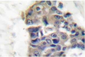 Immunohistochemistry Analysis: AP20200PU-N Synaptotagmin antibody staining of Paraffin-Embedded Human breast carcinoma tissue. (SYT1 antibody)