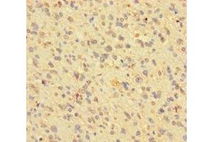 Immunohistochemistry of paraffin-embedded human glioma using ABIN7163790 at dilution of 1:100 (BMI1 antibody  (AA 1-247))