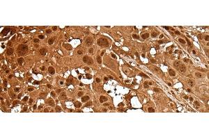 Immunohistochemistry of paraffin-embedded Human esophagus cancer tissue using LAMTOR5 Polyclonal Antibody at dilution of 1:35(x200) (HBXIP antibody)