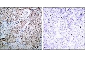 Immunohistochemistry (IHC) image for anti-Tumor Protein P53 (TP53) (pSer315) antibody (ABIN2888498) (p53 antibody  (pSer315))