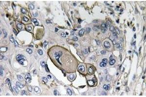 Immunohistochemistry analysis of AQP5 Antibody in paraffin-embedded human lung carcinoma tissue. (Aquaporin 5 antibody)