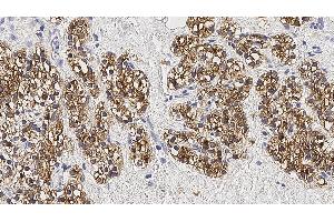 Human parathyroid adenoma: immunohistochemical staining for Parathyroid Hormone. (PTH antibody)