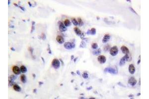 Immunohistochemistry analyzes of Histone H4 antibody in paraffin-embedded human breast carcinoma tissue. (Histone H4 antibody)