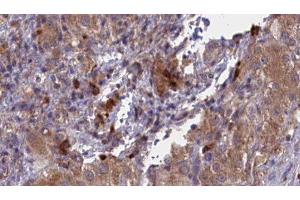 ABIN6277051 at 1/100 staining Human liver cancer tissue by IHC-P. (CD33 antibody  (C-Term))