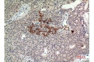 Immunohistochemical analysis of paraffin-embedded human-Breast-cancer, antibody was diluted at 1:100. (STING/TMEM173 antibody  (C-Term))