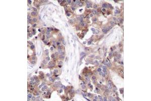 Immunohistochemistry of paraffin-embedded human breast carcinoma using Phospho-STMN1-S25 antibody (ABIN2987641). (Stathmin 1 antibody  (pSer25))
