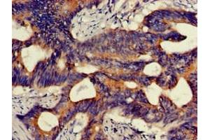Immunohistochemistry of paraffin-embedded human colon cancer using ABIN7163904 at dilution of 1:100 (HMBS antibody  (AA 283-330))