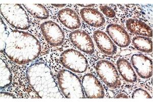 Immunohistochemistry of paraffin-embedded Human colon carcinoma tissue using ATM Monoclonal Antibody at dilution of 1:200. (ATM antibody)