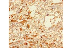 Immunohistochemistry of paraffin-embedded human melanoma using ABIN7159268 at dilution of 1:100 (MAGEA5 antibody  (AA 1-124))