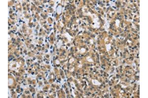 The image on the left is immunohistochemistry of paraffin-embedded Human thyroid cancer tissue using ABIN7129329(EGFL8 Antibody) at dilution 1/30, on the right is treated with fusion protein. (EGFL8 antibody)