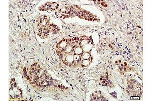 Formalin-fixed and paraffin embedded human ovarian cancer tissue labeled with Rabbit Anti-Acetyl-p53(K382) Polyclonal Antibody (ABIN729673), Unconjugated followed by conjugation to the secondary antibody and DAB staining (p53 antibody  (acLys382))