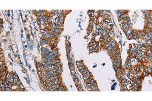 Immunohistochemistry of paraffin-embedded Human gasrtic cancer tissue using ALG2 Polyclonal Antibody at dilution 1:35 (ALG2 antibody)