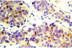 Immunohistochemistry (IHC) analyzes of CHK2 pAb in paraffin-embedded human lung adenocarcinoma tissue. (CHEK2 antibody)