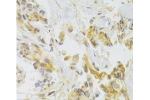 Immunohistochemistry of paraffin-embedded Human breast cancer using EIF4G1 Polyclonal Antibody at dilution of 1:100 (40x lens). (EIF4G1 antibody)