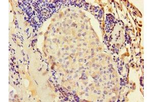 Immunohistochemistry of paraffin-embedded human lung cancer using ABIN7157432 at dilution of 1:100 (KRT6A antibody  (AA 2-564))