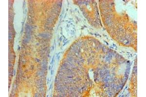 Immunohistochemical of paraffin-embedded Human Colon cancer tissue using ABIN7156047 at dilution of 1:200. (IL1A antibody)