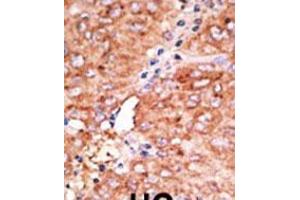 Formalin-fixed and paraffin-embedded human cancer tissue reacted with the primary antibody, which was peroxidase-conjugated to the secondary antibody, followed by AEC staining. (CCBP2 antibody  (C-Term))