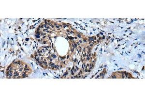 Immunohistochemistry of paraffin-embedded Human cervical cancer tissue using IQGAP1 Polyclonal Antibody at dilution of 1:30(x200) (IQGAP1 antibody)