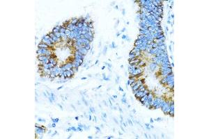 Immunohistochemistry of paraffin-embedded human colon carcinoma using NOX1 antibody (ABIN7268824) at dilution of 1:100 (40x lens). (NOX1 antibody  (AA 200-300))