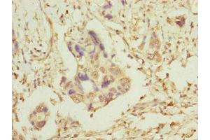 Immunohistochemistry of paraffin-embedded human pancreatic cancer using ABIN7159918 at dilution of 1:100 (TOMM34 antibody  (AA 1-309))