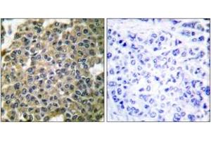 Immunohistochemistry analysis of paraffin-embedded human breast carcinoma tissue, using Keratin 7 Antibody. (Cytokeratin 7 antibody  (AA 420-469))