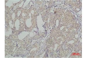 Immunohistochemical analysis of paraffin-embedded human breast caricnoma using SLUG Polyclonal Antibody. (SLUG antibody)