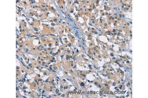 Immunohistochemistry of Human gastric cancer using GAS2 Polyclonal Antibody at dilution of 1:50 (GAS2 antibody)
