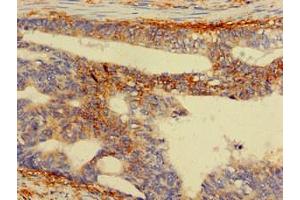 Immunohistochemistry of paraffin-embedded human colon cancer using ABIN7142563 at dilution of 1:100 (RPS5 antibody  (AA 1-204))