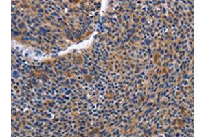 The image on the left is immunohistochemistry of paraffin-embedded Human liver cancer tissue using ABIN7129821(IGSF10 Antibody) at dilution 1/50, on the right is treated with fusion protein. (IGSF1 antibody)