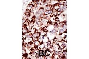 Formalin-fixed and paraffin-embedded human cancer tissue reacted with the primary antibody, which was peroxidase-conjugated to the secondary antibody, followed by DAB staining. (PIGK antibody  (C-Term))