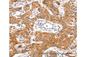 Immunohistochemistry of Human liver cancer using NUAK1 Polyclonal Antibody at dilution of 1:70 (NUAK1 antibody)