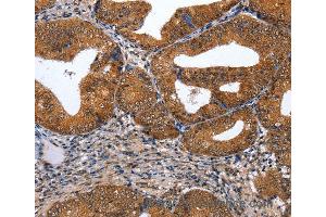 Immunohistochemistry of Human cervical cancer using GATA6 Polyclonal Antibody at dilution of 1:35 (GATA6 antibody)