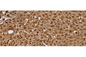Immunohistochemistry of paraffin-embedded Human lung cancer tissue using LAMTOR5 Polyclonal Antibody at dilution of 1:35(x200) (HBXIP antibody)