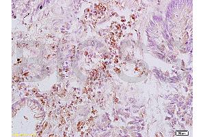 Formalin-fixed and paraffin embedded human rectal carcinoma labeled with Anti-Integrin beta 3/CD61 Polyclonal Antibody, Unconjugated (ABIN739029) at 1:200, followed by conjugation to the secondary antibody and DAB staining (Integrin beta 3 antibody  (AA 27-120))