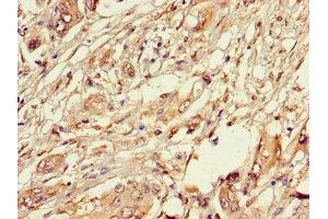 Immunohistochemistry of paraffin-embedded human pancreatic cancer using ABIN7162891 at dilution of 1:100 (PLIN3 antibody  (AA 192-324))