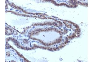 Formalin-fixed, paraffin-embedded human Thyroid Carcinoma stained with TSHRA Monoclonal Antibody (SPM223). (TSH receptor antibody)