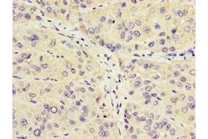 Immunohistochemistry of paraffin-embedded human liver cancer using ABIN7162964 at dilution of 1:100 (CROT antibody  (AA 1-87))