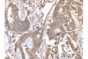 The image on the left is immunohistochemistry of paraffin-embedded Human colon cancer tissue using ABIN7128119(ABCB6 Antibody) at dilution 1/15, on the right is treated with fusion protein. (ABCB6 antibody)
