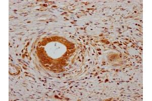 IHC image of ABIN7139767 diluted at 1:200 and staining in paraffin-embedded human gastric cancer performed on a Leica BondTM system. (CA9 antibody  (AA 38-414))