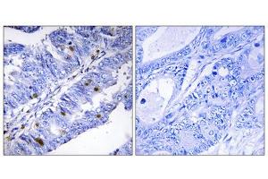 Immunohistochemistry analysis of paraffin-embedded human colon carcinoma tissue using Nuclear Receptor NR4A1 (Phospho-Ser351) antibody. (NR4A1 antibody  (pSer351))