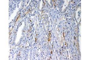 IHC testing of FFPE human colon cancer tissue with VEGFD antibody at 1ug/ml. (VEGFD (VEGF4) (AA 89-205) antibody)