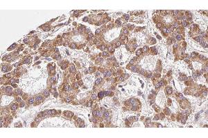 ABIN6279548 at 1/100 staining Human liver cancer tissue by IHC-P. (SLC16A9 antibody  (Internal Region))