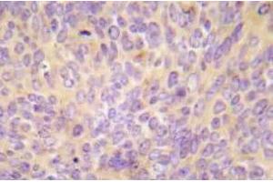 Immunohistochemistry (IHC) analyzes of ASK1 antibody in paraffin-embedded human lung adenocarcinoma tissue. (ASK1 antibody)