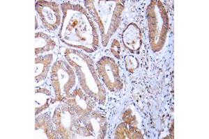 Immunohistochemical analysis of MRPL24 staining in human colon cancer formalin fixed paraffin embedded tissue section. (MRPL24 antibody  (Center))