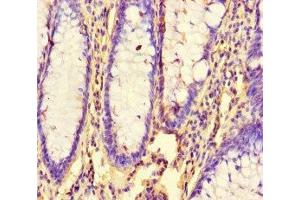 Immunohistochemistry of paraffin-embedded human colon cancer using ABIN7154592 at dilution of 1:100 (RHEB antibody  (AA 1-182))