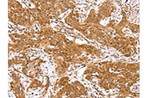 The image on the left is immunohistochemistry of paraffin-embedded Human cervical cancer tissue using ABIN7130874(RGS22 Antibody) at dilution 1/40, on the right is treated with fusion protein. (RGS22 antibody)