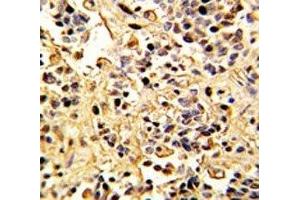 IHC analysis of FFPE human kidney carcinoma with Neprilysin antibody (MME antibody  (AA 506-534))