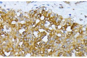 Immunohistochemistry of paraffin-embedded Human breast cancer using ATG7 Polyclonal Antibody at dilution of 1:100 (40x lens). (ATG7 antibody)